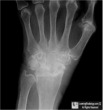 CPPD Arthropathy